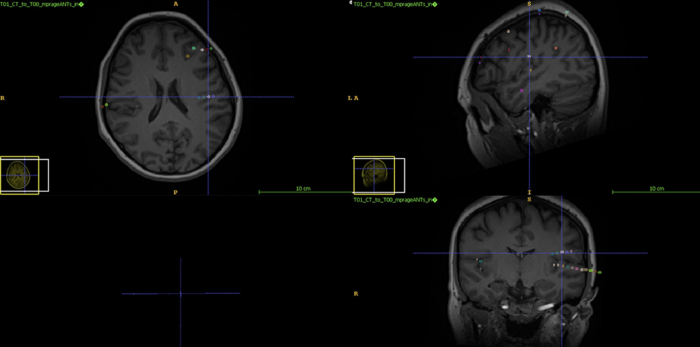 Figure 1 SEEG Slide 29